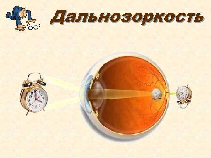 Дальнозоркость 