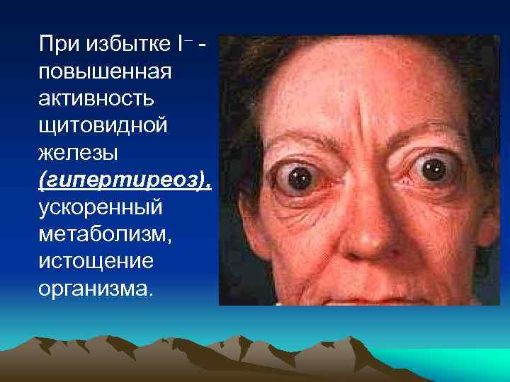 При избытке I– повышенная активность щитовидной железы (гипертиреоз), ускоренный метаболизм, истощение организма. 