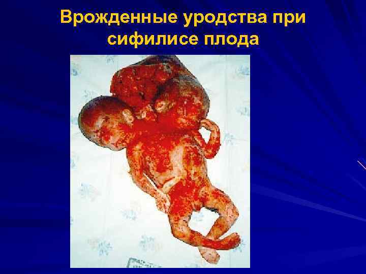 Врожденные уродства при сифилисе плода 