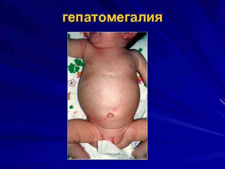 гепатомегалия 