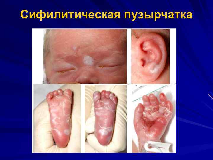 Сифилитическая пузырчатка 