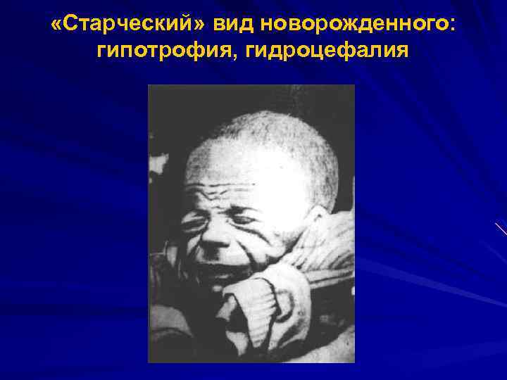  «Старческий» вид новорожденного: гипотрофия, гидроцефалия 