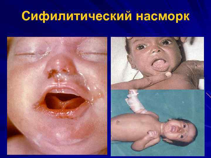 Сифилитический насморк 