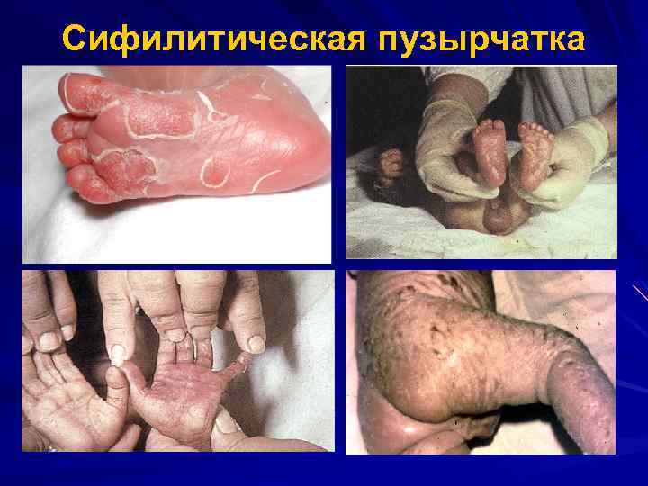 Сифилитическая пузырчатка 