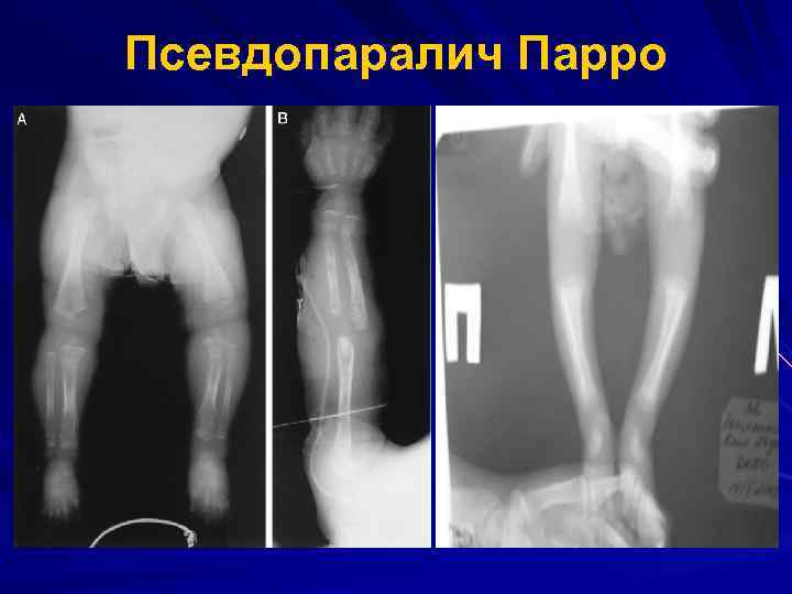 Псевдопаралич Парро 