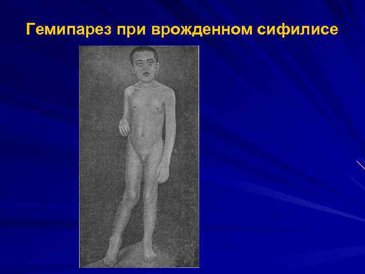Гемипарез при врожденном сифилисе 