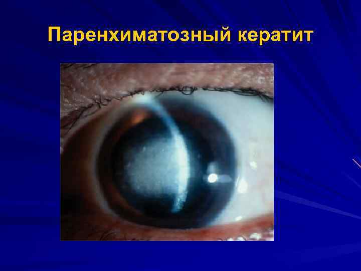 Паренхиматозный кератит 