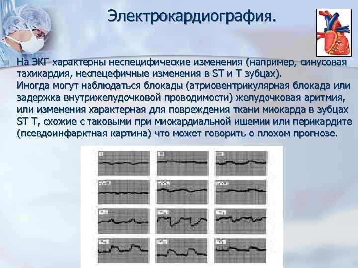 Электрокардиография. n На ЭКГ характерны неспецифические изменения (например, синусовая тахикардия, неспецефичные изменения в ST