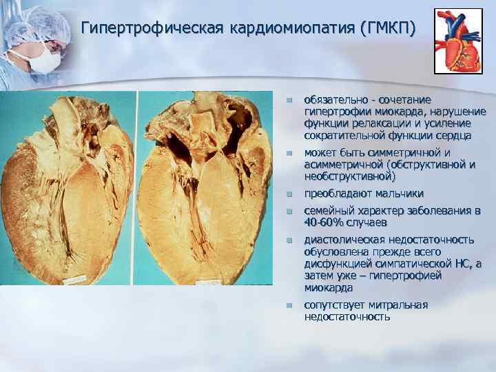 Гипертрофическая кардиомиопатия (ГМКП) n обязательно - сочетание гипертрофии миокарда, нарушение функции релаксации и усиление