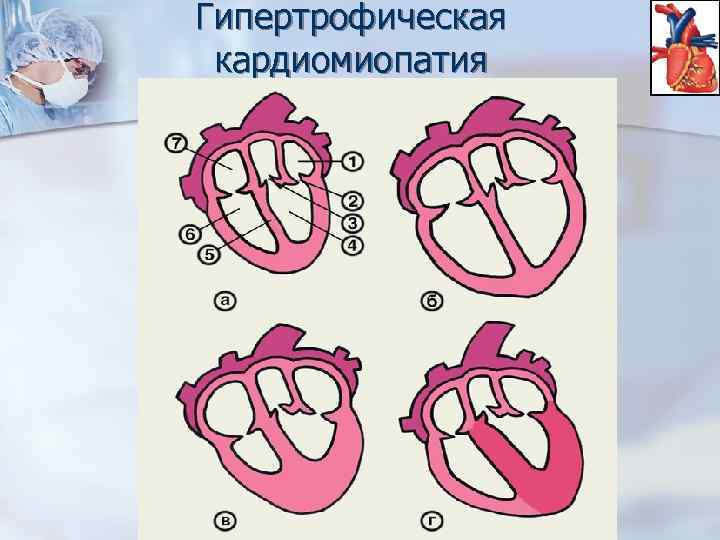 Гипертрофическая кардиомиопатия 