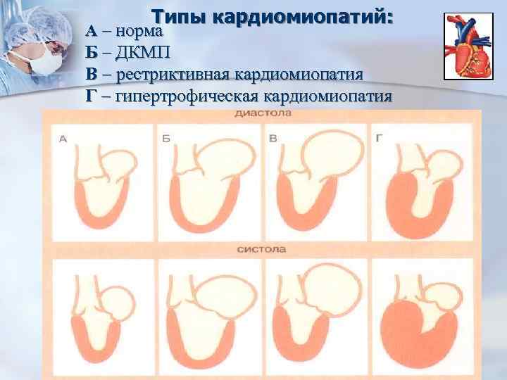 Типы кардиомиопатий: А – норма Б – ДКМП В – рестриктивная кардиомиопатия Г –