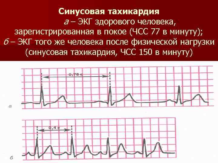 Клиническая картина аритмии