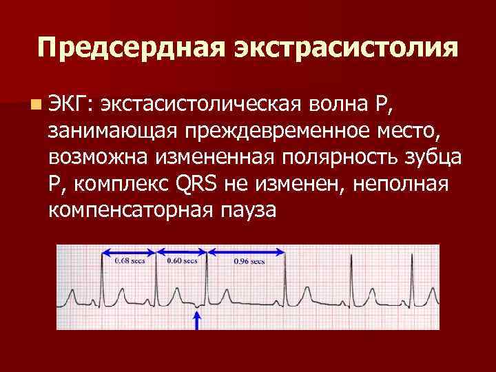 Предсердная экстрасистолия n ЭКГ: экстасистолическая волна Р, занимающая преждевременное место, возможна измененная полярность зубца