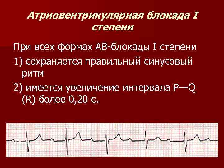 Атриовентрикулярная блокада I степени При всех формах АВ-блокады I степени 1) сохраняется правильный синусовый