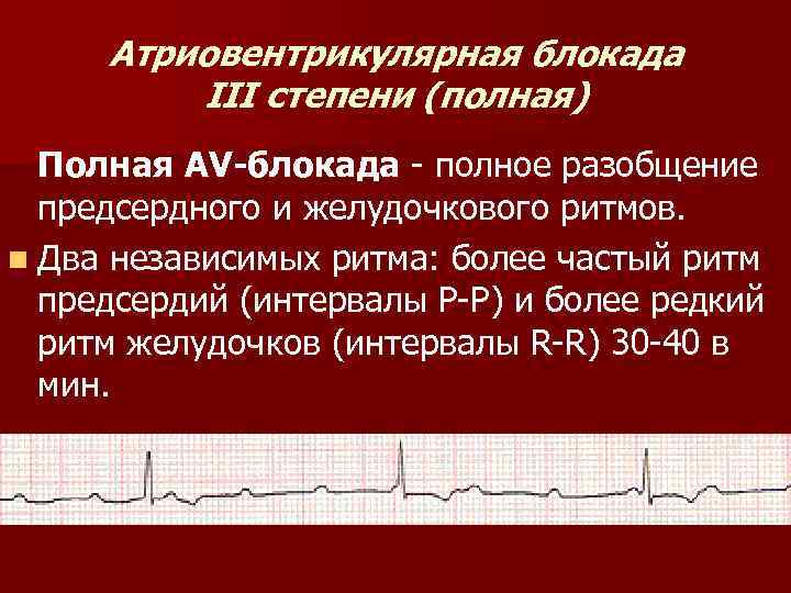 Атриовентрикулярная блокада признаки. Атриовентрикулярная блокада 3. Атриовентрикулярная блокада 3степ. Атриовентрикулярная блокада 3 ст. Механизм АВ блокады 3 степени.