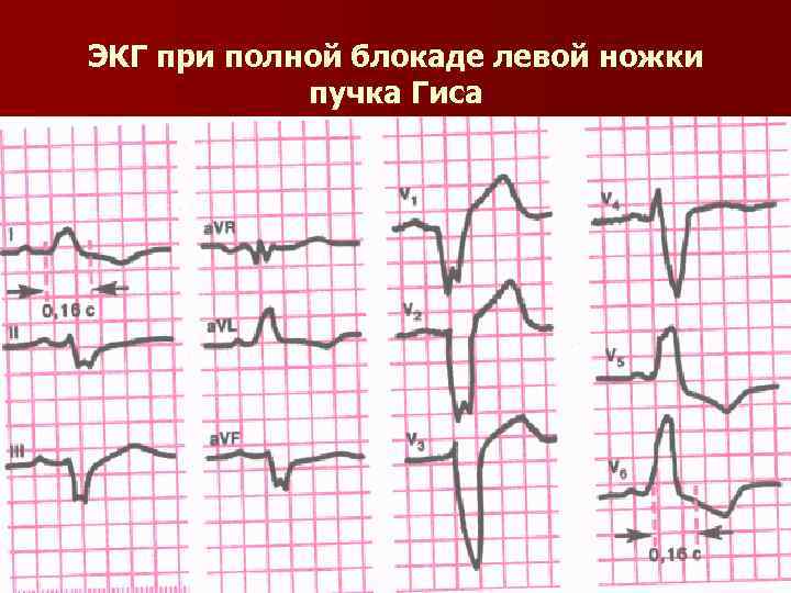 Блокада левой ножки на экг