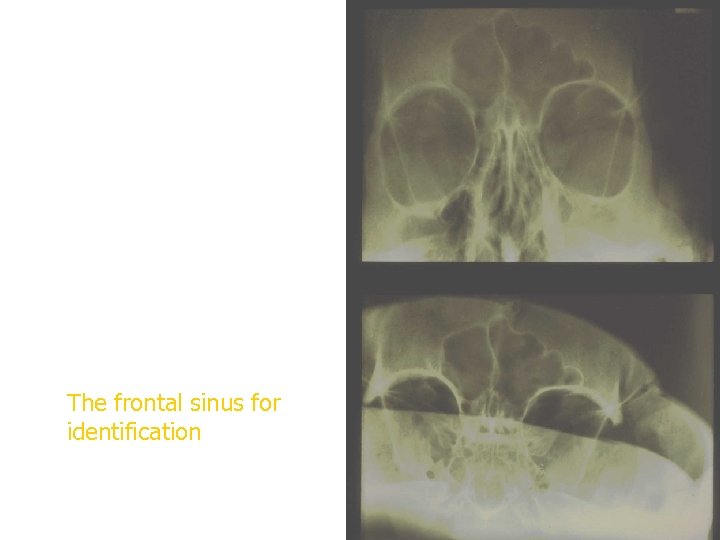 The frontal sinus for identification 