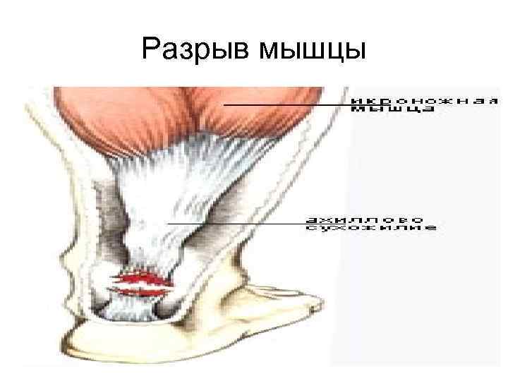 Повреждение мышц. Как выглядит разорванная мышца.