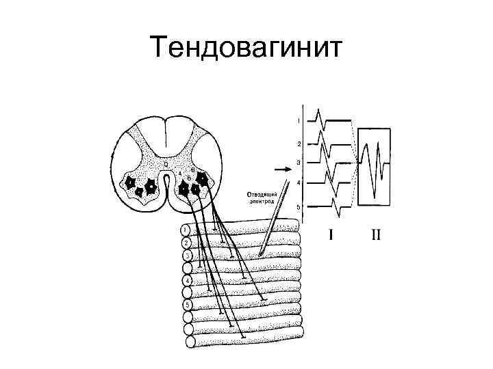 Тендовагинит 