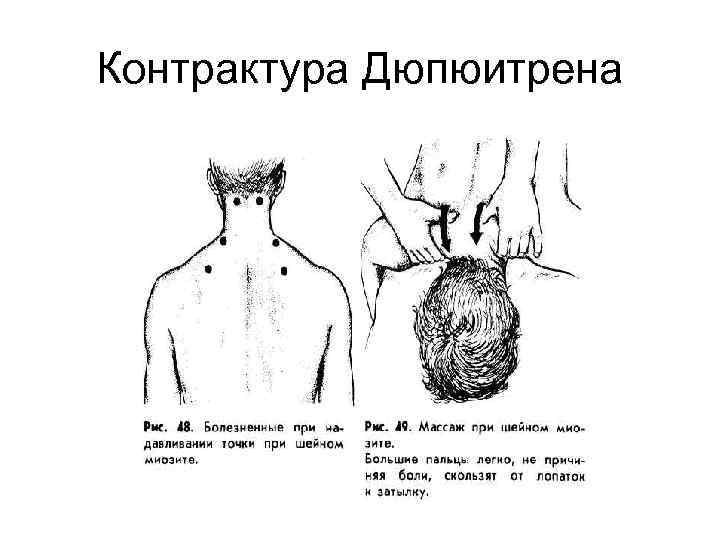 Контрактура это. Контрактура мышц физиология. Динамическая контрактура мышц. Мышцы образующие контрактуры.