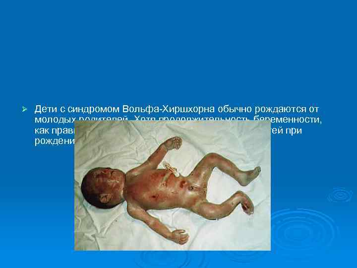 Ø Дети с синдромом Вольфа-Хиршхорна обычно рождаются от молодых родителей. Хотя продолжительность беременности, как