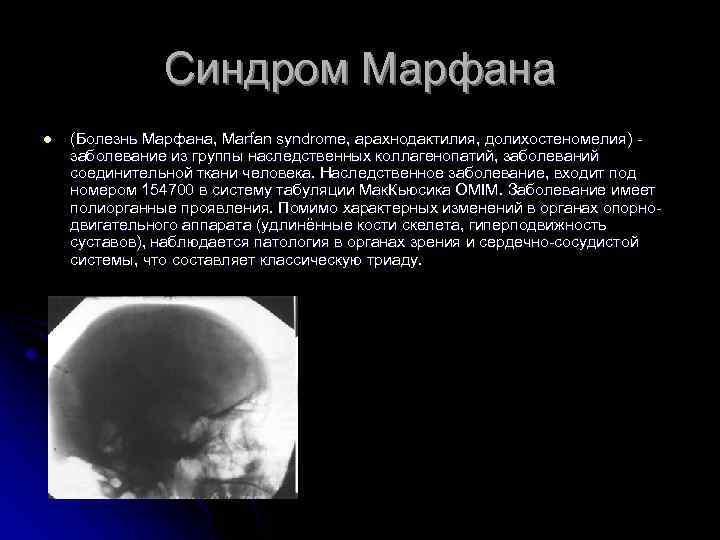 Синдром Марфана l (Болезнь Марфана, Marfan syndrome, арахнодактилия, долихостеномелия) заболевание из группы наследственных коллагенопатий,