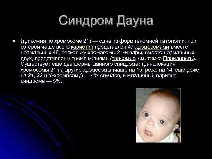 Синдром Дауна l (трисомия по хромосоме 21) — одна из форм геномной патологии, при