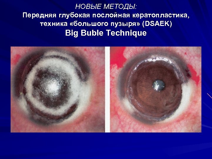 НОВЫЕ МЕТОДЫ: Передняя глубокая послойная кератопластика, техника «большого пузыря» (DSAEK) Big Buble Technique 
