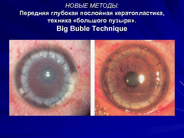 НОВЫЕ МЕТОДЫ: Передняя глубокая послойная кератопластика, техника «большого пузыря» . Big Buble Technique 