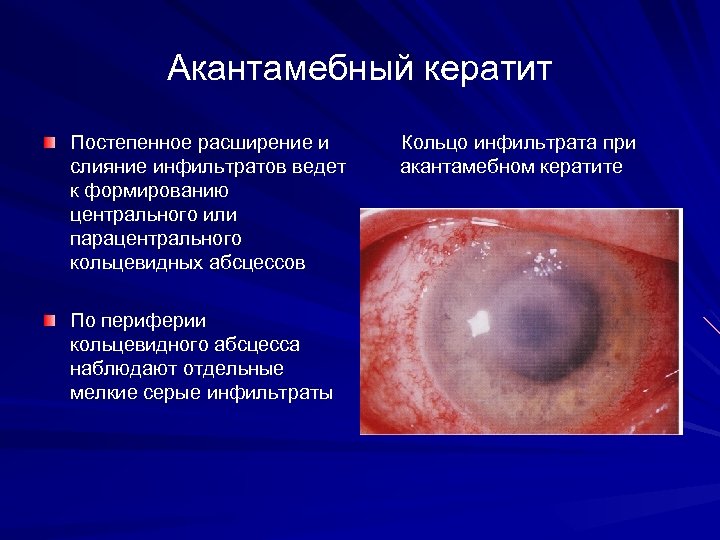 Акантамебный кератит Постепенное расширение и слияние инфильтратов ведет к формированию центрального или парацентрального кольцевидных