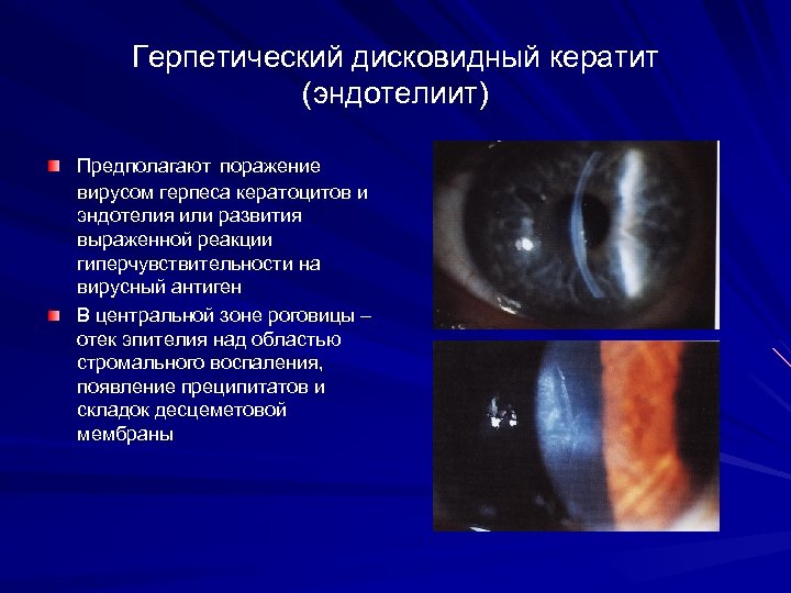 Герпетический дисковидный кератит (эндотелиит) Предполагают поражение вирусом герпеса кератоцитов и эндотелия или развития выраженной