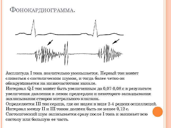 ФОНОКАРДИОГРАММА. Амплитуда I тона значительно уменьшается. Первый тон может сливаться с систолическим шумом, и