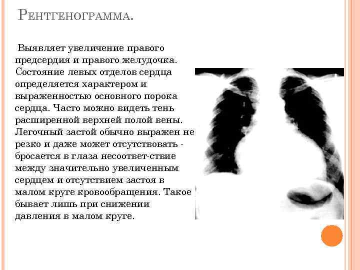 РЕНТГЕНОГРАММА. Выявляет увеличение правого предсердия и правого желудочка. Состояние левых отделов сердца определяется характером