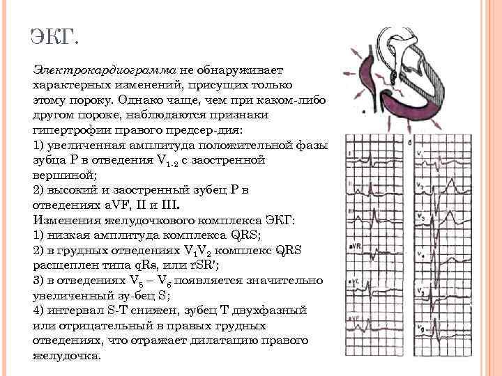 ЭКГ. Электрокардиограмма не обнаруживает характерных изменений, присущих только этому пороку. Однако чаще, чем при