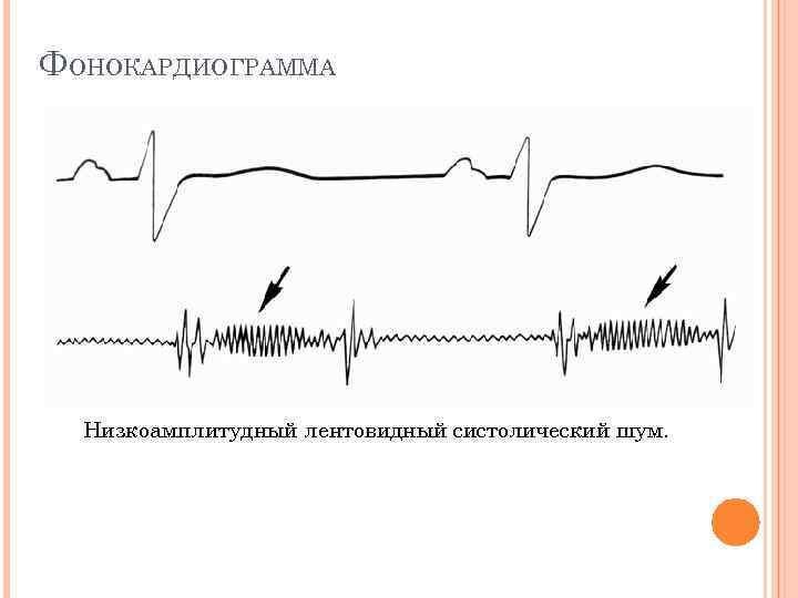 ФОНОКАРДИОГРАММА Низкоамплитудный лентовидный систолический шум. 