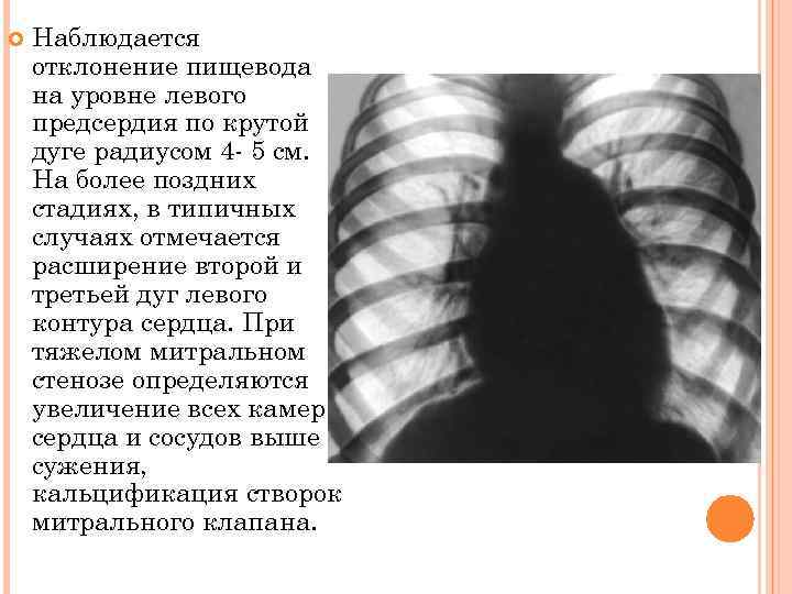  Наблюдается отклонение пищевода на уровне левого предсердия по крутой дуге радиусом 4 5