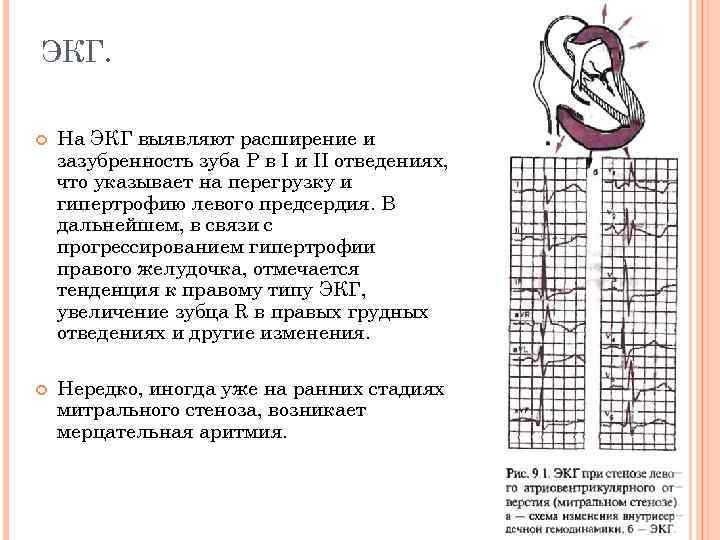 ЭКГ. На ЭКГ выявляют расширение и зазубренность зуба Р в I и II отведениях,