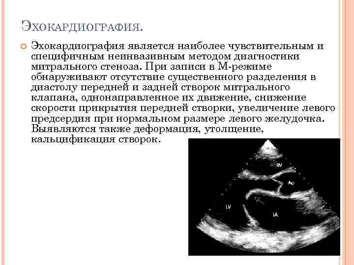 Эхокардиография анализ. Методы эхокардиографии. Алгоритм эхокардиографии. Эхокардиография расшифровка.