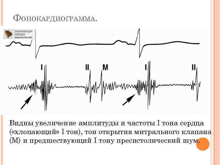 ФОНОКАРДИОГРАММА. Видны увеличение амплитуды и частоты I тона сердца ( «хлопающий» I тон), тон