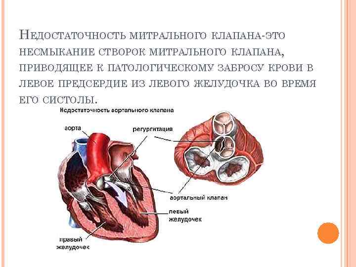 Дополнительная хорда митрального клапана