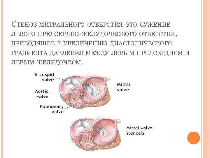 Градиент между желудочками. Декомпенсация при митральном стенозе. Сужение митрального отверстия. Стеноз митрального отверстия. Этапы компенсации митрального стеноза.