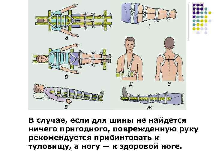 В случае, если для шины не найдется ничего пригодного, поврежденную руку рекомендуется прибинтовать к
