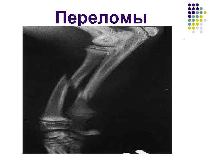 Переломы 