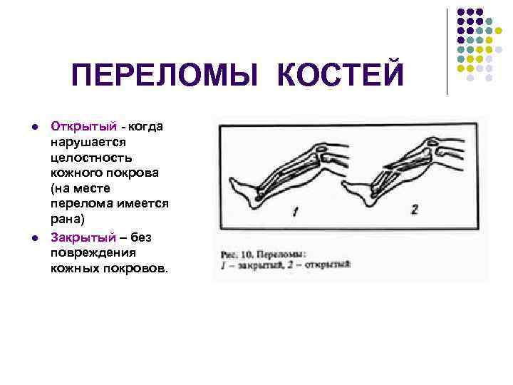 ПЕРЕЛОМЫ КОСТЕЙ l l Открытый - когда нарушается целостность кожного покрова (на месте перелома