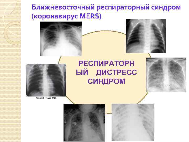Ближневосточный респираторный синдром (коронавирус MERS) РЕСПИРАТОРН ЫЙ ДИСТРЕСС СИНДРОМ 