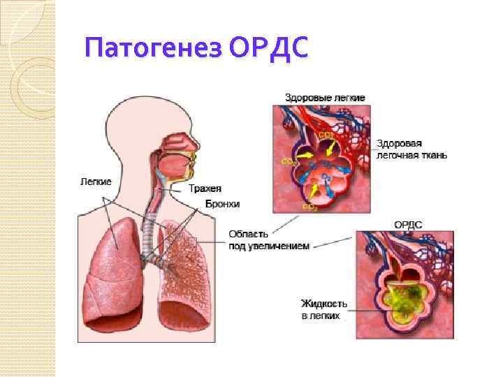 Патогенез ОРДС 