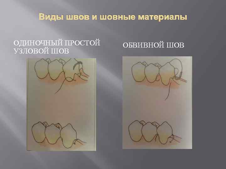 Виды швов и шовные материалы ОДИНОЧНЫЙ ПРОСТОЙ УЗЛОВОЙ ШОВ ОБВИВНОЙ ШОВ 