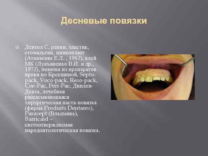Десневые повязки Дентол С, репин, эластик, стомальгин, цинкопласт (Атанасова Е. Л. , 1962), клей