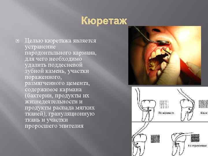 Кюретаж Целью кюретажа является устранение пародонтального кармана, для чего необходимо удалить поддесневой зубной камень,