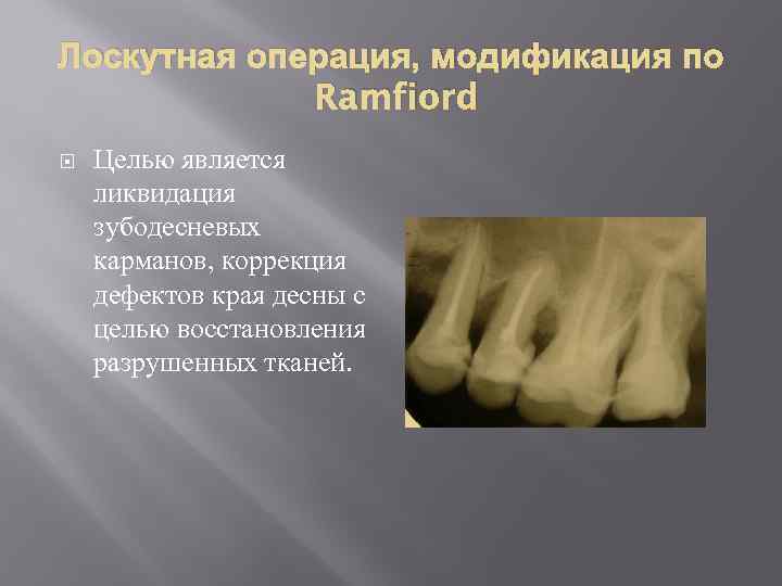 Лоскутная операция, модификация по Ramfiord Целью является ликвидация зубодесневых карманов, коррекция дефектов края десны
